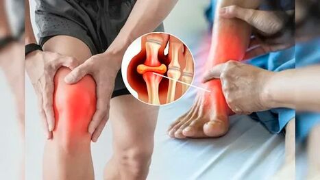 Področja kože primerna za nanos Icexin gela (kolena, komolci, križ)