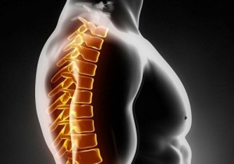 Torakalna osteohondroza spremlja bolečina in nelagodje na sredini hrbta