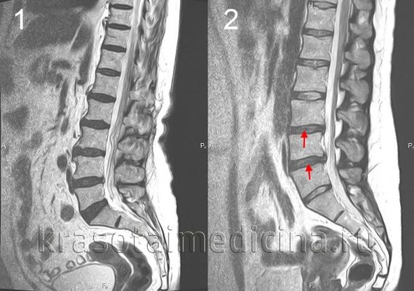 osteohondroza hrbtenice